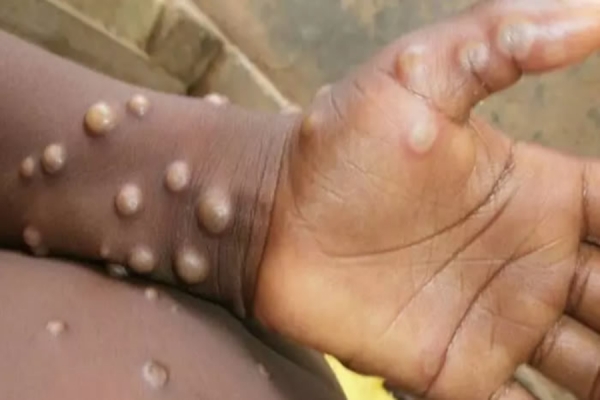 Ministério da Saúde confirma 3º caso da varíola dos macacos no Brasil